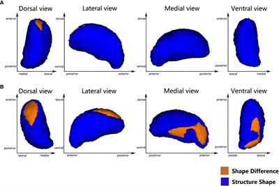 Effects of hypertension on subcortical nucleus morphological alternations in patients with type 2 diabetes